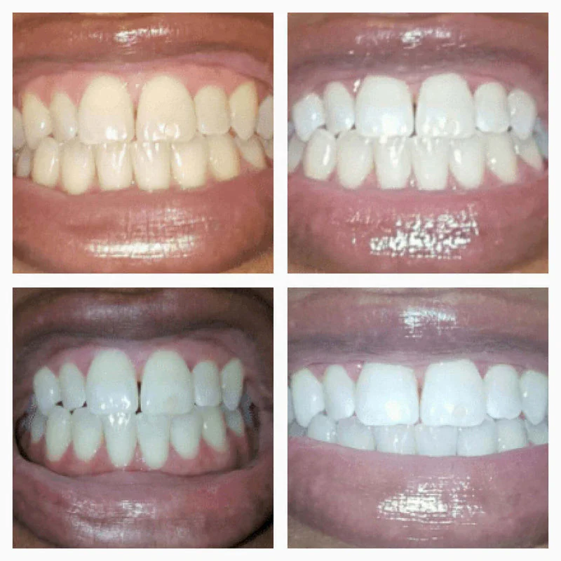 Teeth Whitening Gold Serum Pen - Image 5