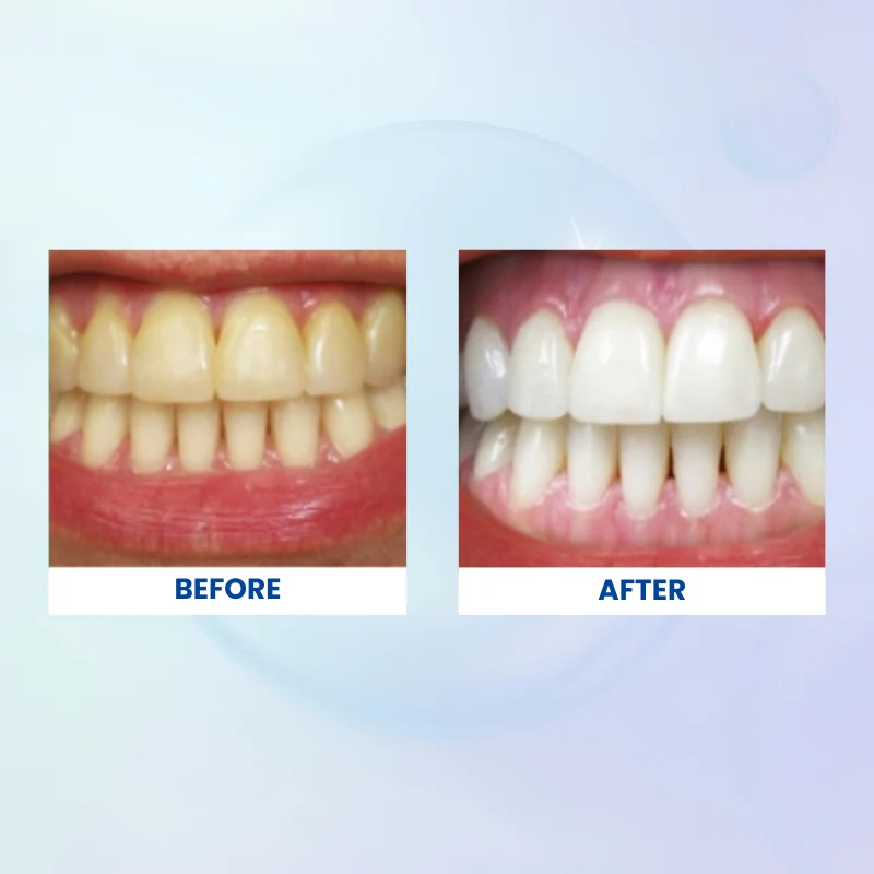 Whitening Strips - Image 6